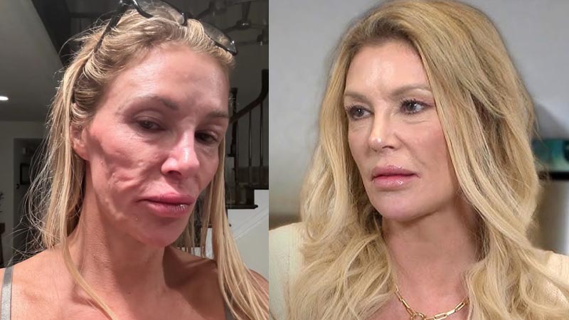  “I’ve Lost Five Teeth Out of My Head,” Brandi Glanville Opens Up About Stress-Induced Angioedema and Recovery Journey